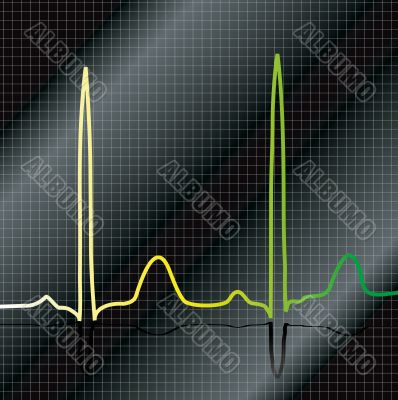gradient ecg