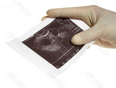 Hands with sonography