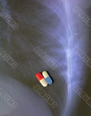 Lung infection combined therapy