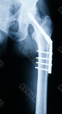 X-ray of a Hip