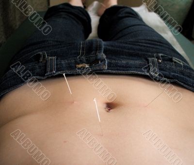 Acupuncture Appointment