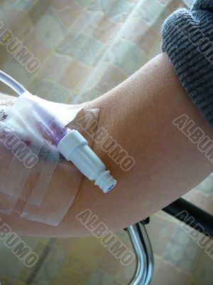 Patient`s Arm Prepped For IV