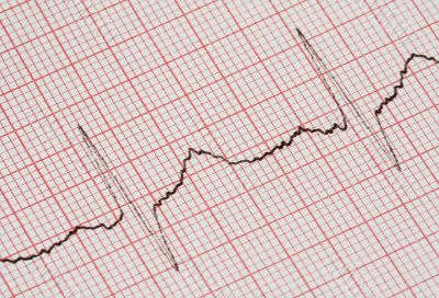 ECG graph