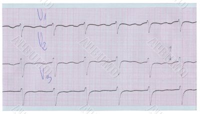 long stripe of ecg