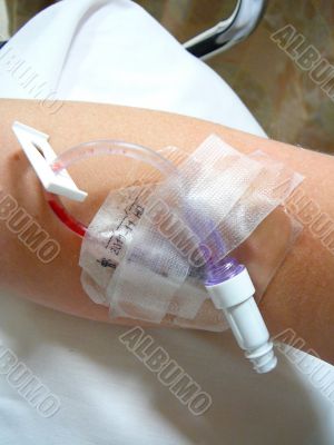 Patient`s Arm Prepped For I.V.