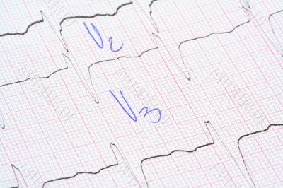 ECG graph with doctor notes