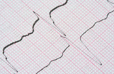 ECG graph