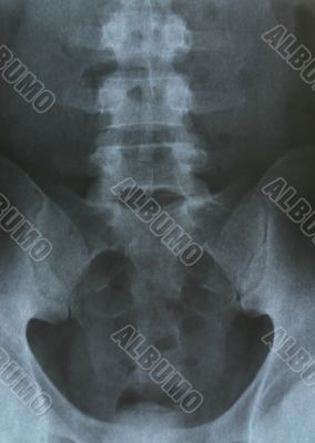 pelvis x-ray