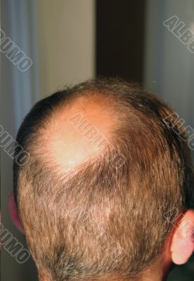 balding head