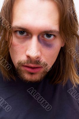 Young man with black eye