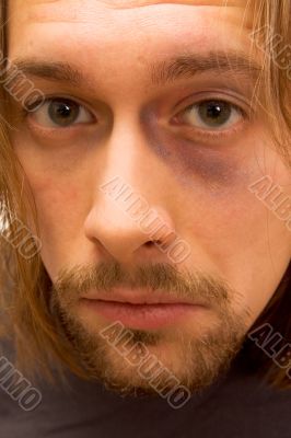 Young man with black eye