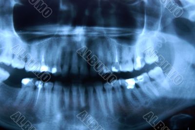 roentgen - jaw, nandible