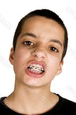 teenage showing his dental braces teenage showing his dental braces