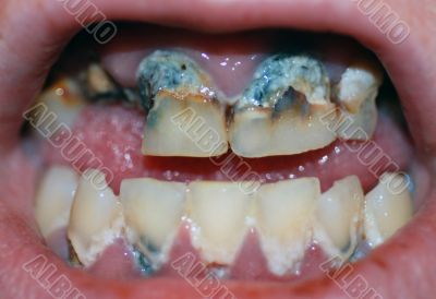 Severe Tooth Decay