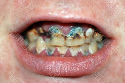 Mouth with Severe Tooth Decay