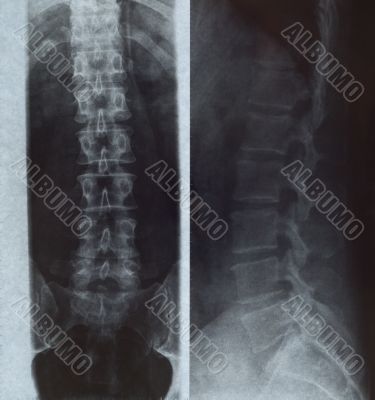 xray of human spine