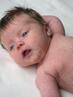 young baby with a rash