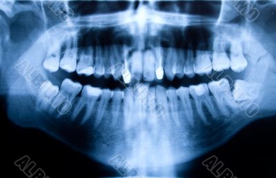Dental X-ray