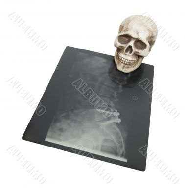 Bones and xrays