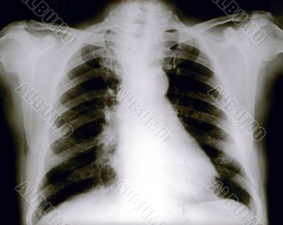 Chest X ray. Human.