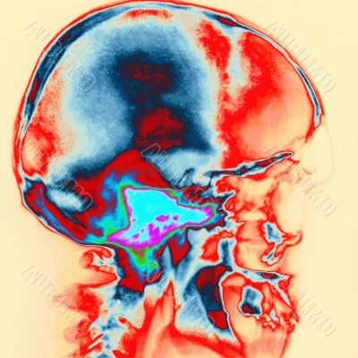 Skull X ray on human head