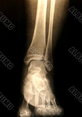 X-ray of a foot