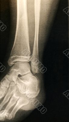 X-ray of a foot