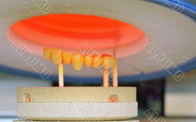 dental crowns, ceramics, furnace