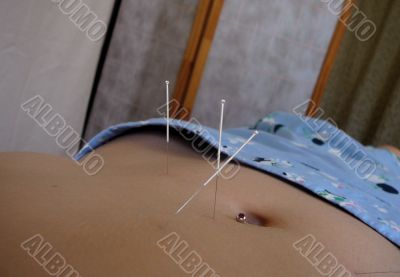 Acupuncture Appointment