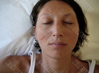 Acupuncture Appointment