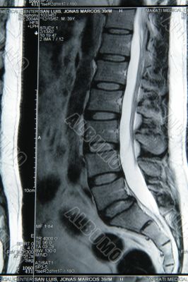 MRI result 1