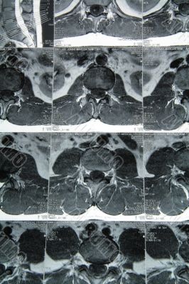 MRI result 3