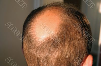 balding head