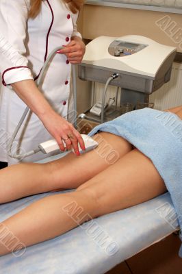 laser epilation