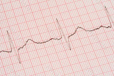 ECG printout