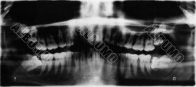 fluoroscopic image