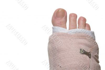 Broken Foot