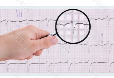 closer look at ECG printout