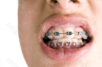 dental braces
