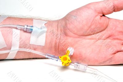 Patient IV