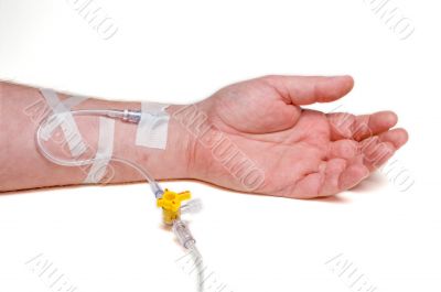 Patient IV