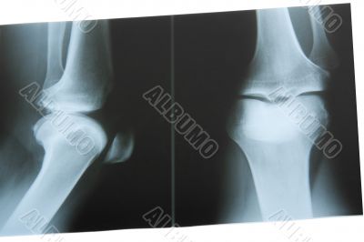 X-Ray Photo