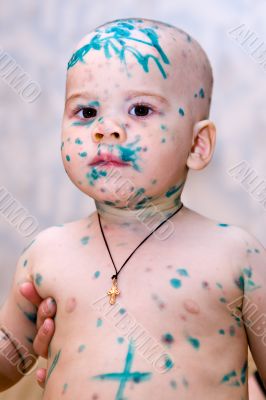 Chicken pox