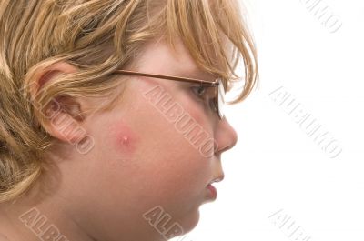 Boy with Acne