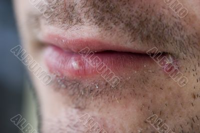 Cold sores (herpes labialis)