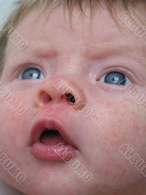 young baby with a rash