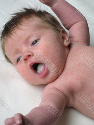 young baby with a rash