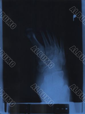 x-ray