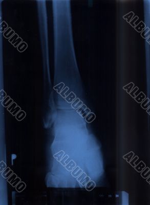 x-ray