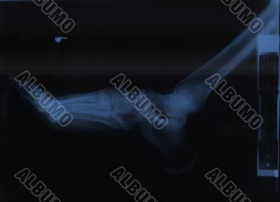 x-ray